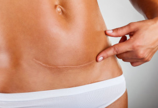 A depender do caso de cisto no ovário, a cirurgia pode ser recomendada pelo médico - Foto: Shutterstock