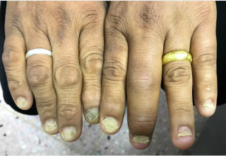 Artrite psoriásica interfalangeal distal predominante afeta principalmente as articulações de dedos das mãos - Foto: Shutterstock