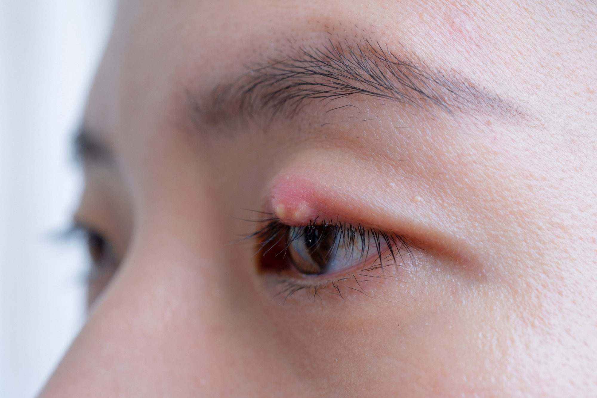 Clínica de olhos Levate - 👀 Terçol ou Hordéolo: 1. O que é? Pequeno nódulo  infeccioso na região palpebral, mais precisamente na base dos cílios.  Geralmente ocorre por uma obstrução das glândulas