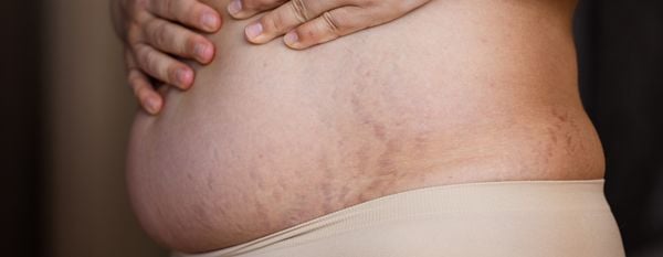 Foto aproximada de barriga de mulher com estrias roxas; estrias no abdômen estão entre os sintomas de síndrome de cushing