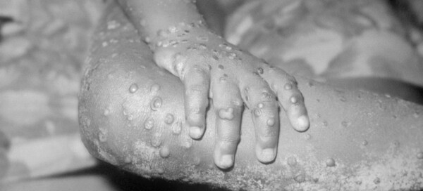 Foto aproximada de criança com lesões na pele típicas da varíola dos macacos