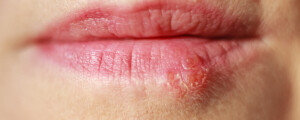 Foto aproximada de boca de mulher com herpes labial