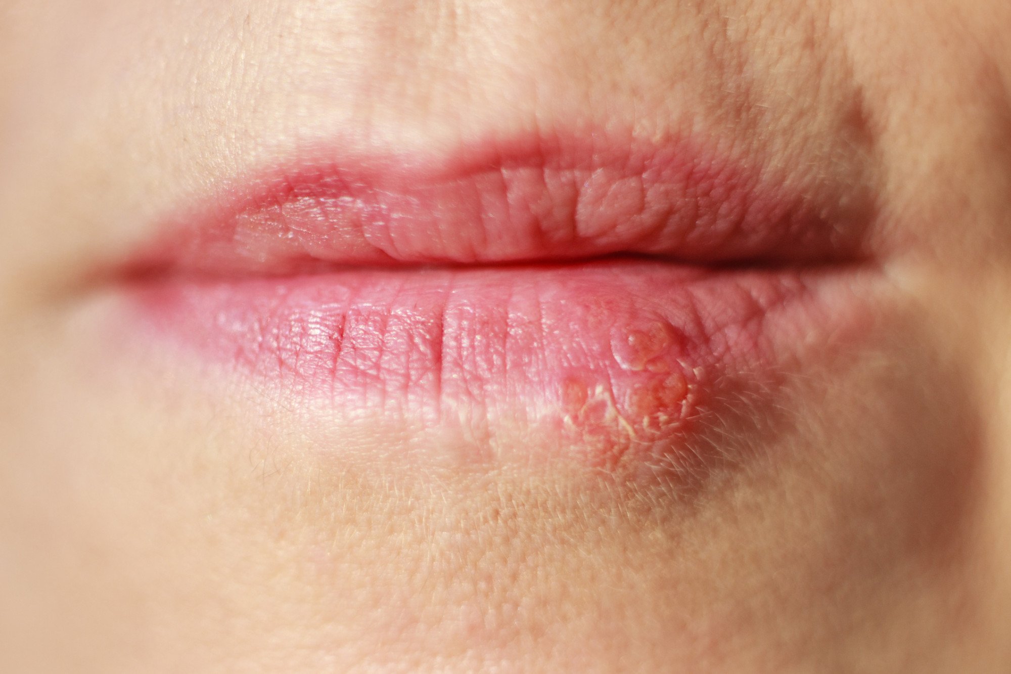 What Does A Healing Herpes Sore Look Like