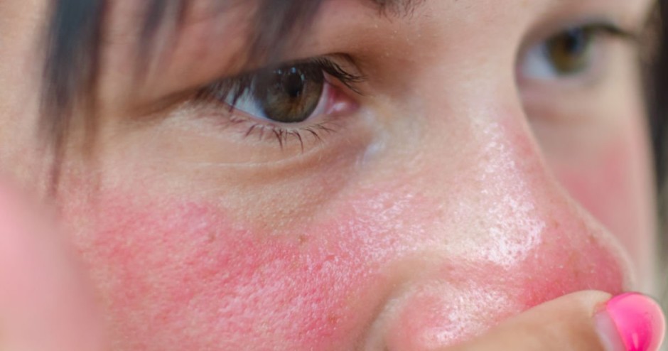  Vermelhidão em forma de borboleta sobre as bochechas e a ponta do nariz é um dos sintomas do lúpus - Foto: Shutterstock