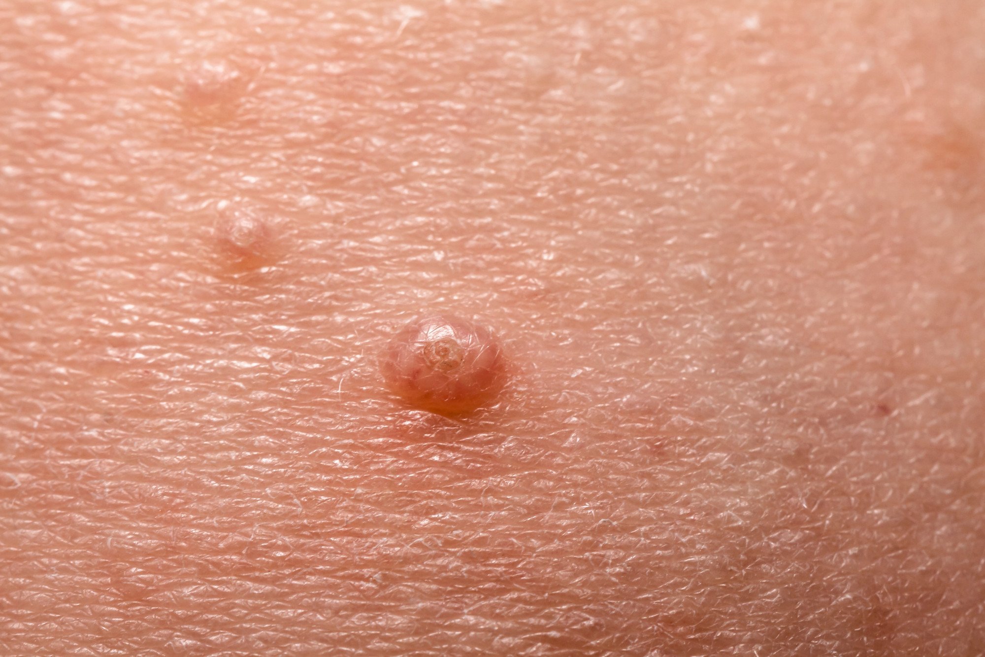 Caroços na pele: doenças relacionadas - Minha Vida