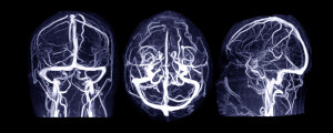 Imagem de um exame de ressonância magnética para diagnóstico de aneurisma cerebral
