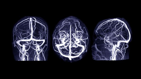 Imagem de um exame de ressonância magnética para diagnóstico de aneurisma cerebral