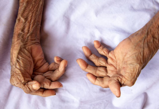 Artrite psoriásica mutilante causa destruição nas juntas - Foto: Shutterstock