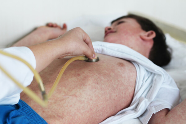 Imagem aproximada de médico examinando um garoto com sarampo