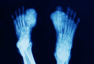 Exame de imagem mostra acúmulo de ácido úrico nos pés - Foto: Shutterstock