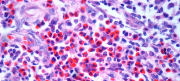 células sanguíneas afetadas pelo cancêr