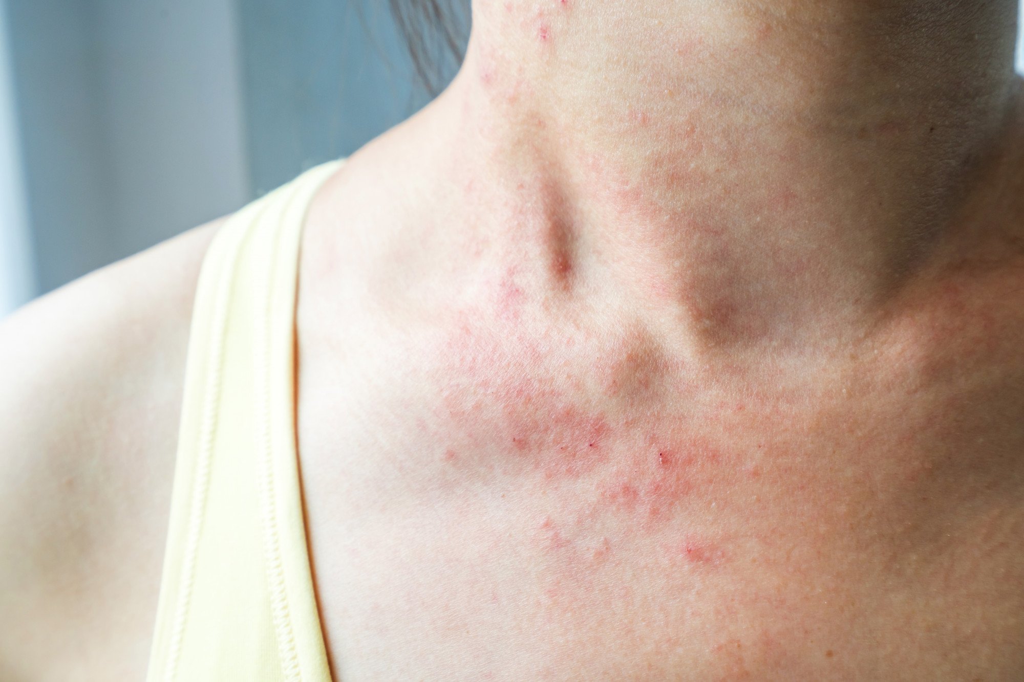 Intertrigo - Distúrbios da pele - Manual MSD Versão Saúde para a Família