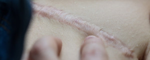 Cicatriz longa na pele