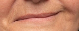 Foto da boca de uma mulher branca tentando sorrir, mas com um lado do rosto paralisado, deixando o lábio torto