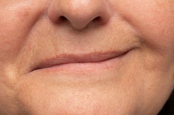 Foto da boca de uma mulher branca tentando sorrir, mas com um lado do rosto paralisado, deixando o lábio torto