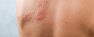 Foto aproximada de costas infectada pelo vírus da herpes zoster, apresentando erupções rosadas e agrupadas