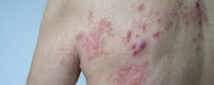 pessoa com bolhas avermelhadas nas costas, um dos sintomas da dermatite