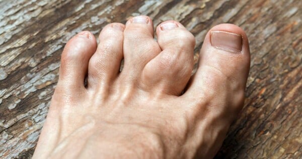 Foto de dedos do pé com nódulos causados pela gota