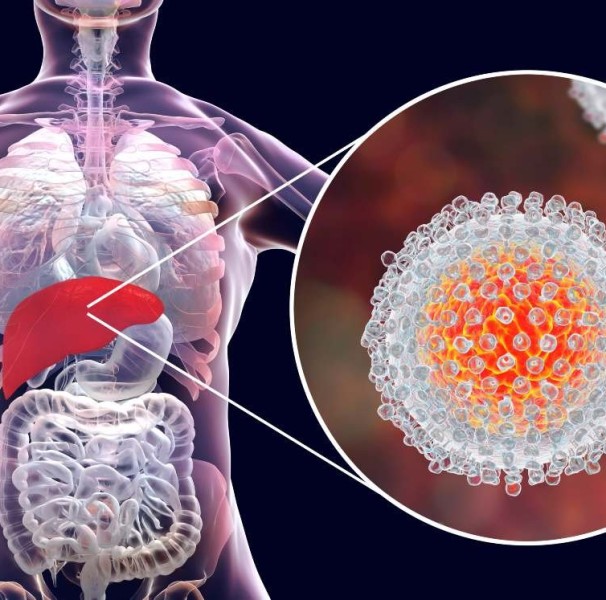 Hepatite C: Transmissão, Sintomas E Tratamento - Minha Vida