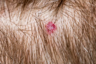 Foliculite no couro cabeludo - Foto: Shutterstock