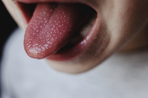 Criança com a língua de morango devido escarlatina