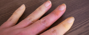 Mão com sintomas de esclerodermia