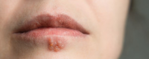 Foto aproximada de boca de mulher, de pele branca, com bolhas causadas pelo vírus do herpes