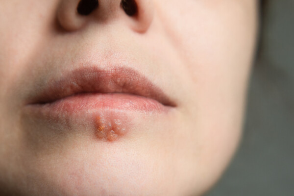 Foto aproximada de boca de mulher, de pele branca, com bolhas causadas pelo vírus do herpes