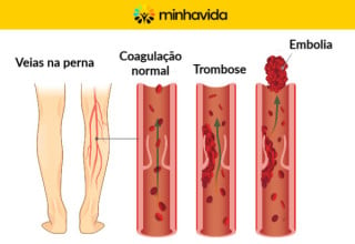 Diferenças entre coagulação normal, trombose e embolia - Imagem: Minha Vida