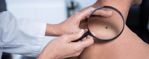 Mãos de um médico examinando um câncer de pele nas costas de um homem com uma lupa