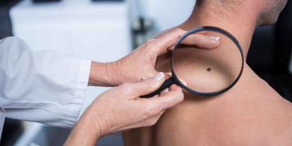 Mãos de um médico examinando um câncer de pele nas costas de um homem com uma lupa