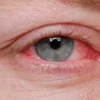 Herpes ocular