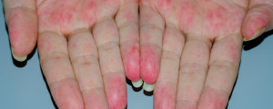 Foto de uma mão com manchas típicas de vasculite