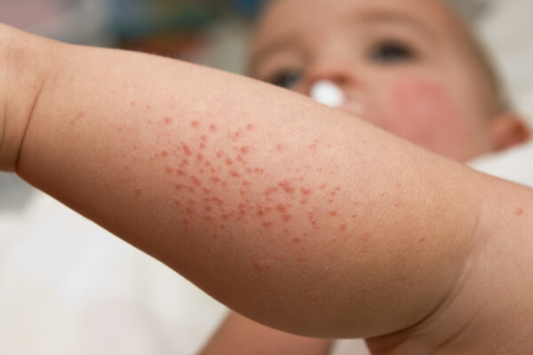 bebê com dermatite de contato no braço