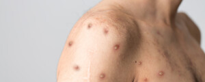 Close de ombro de um homem com lesões da varíola