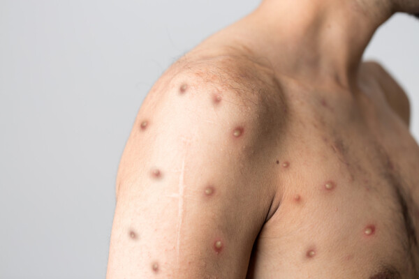 Close de ombro de um homem com lesões da varíola