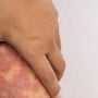 Dermatite e úlceras de estase