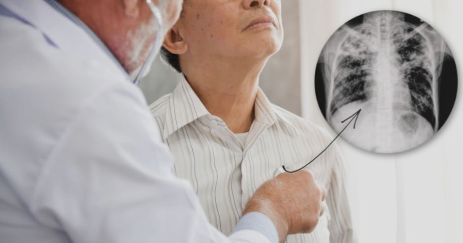 Pneumonia é uma infecção nos pulmões que pode ser fatal - Foto: Shutterstock