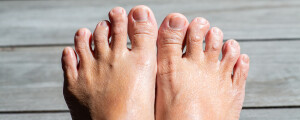 Deformação nos dedos dos pés