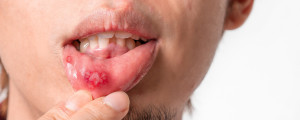 Homem com úlceras orais nos lábios