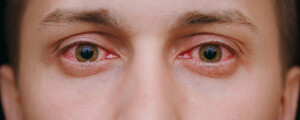 homem com o olho avermelhado