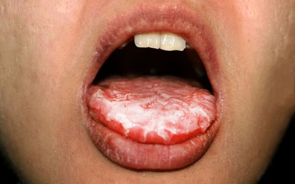 imagem aproximada de uma boca aberta com a língua com manchas brancas