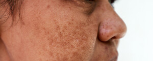 Close do rosto de uma mulher com manchas na bochecha