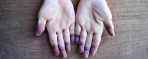 mãos cianóticas com dedos azulados