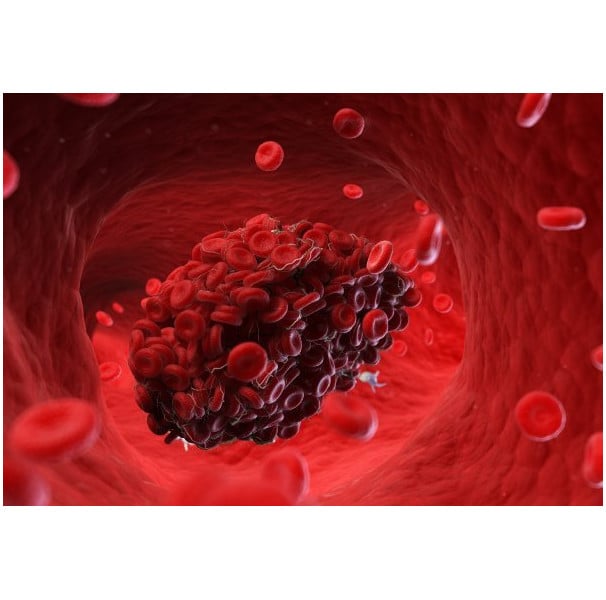Coágulo de sangue: causas, tipos e tratamentos - Minha Vida