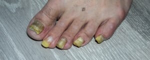 imagem aproximada de um pé com unhas amareladas