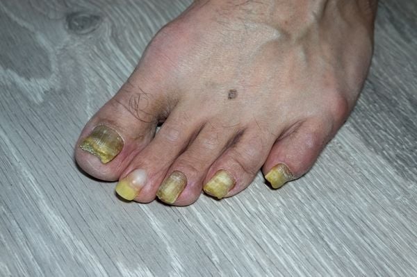 imagem aproximada de um pé com unhas amareladas