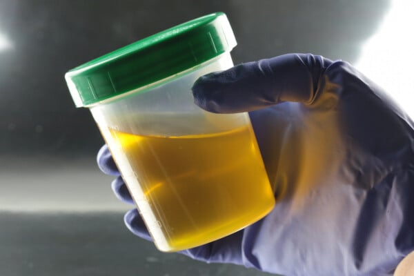 Pote de armazenamento de urina para exames