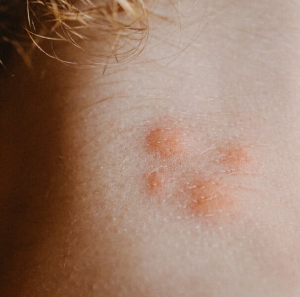 Caroços na pele: o que podem ser e tratamento - Minha Vida