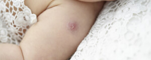 Bebê com uma cicatriz avermelhada no braço devido a vacina BCG